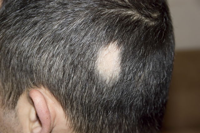 Illustrative image of the article Alopecia Areata: Symptoms, Causes & Treatment