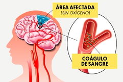 Imagen ilustrativa del artículo Trombosis cerebral: síntomas, secuelas y tratamiento