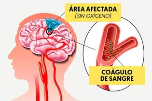 Imagen ilustrativa del artículo Trombosis cerebral: síntomas, secuelas y tratamiento