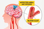 Illustrative image of the article Ischemic Stroke: Symptoms, Causes & Treatment