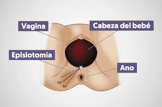 imagen ilustrativa de la episiotomía