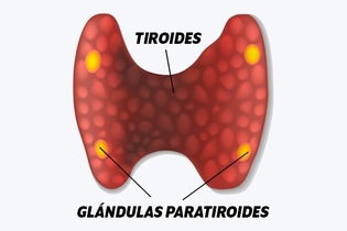Imagen ilustrativa del artículo Hiperparatiroidismo: qué es, síntomas y tratamiento