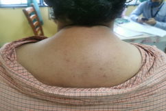 Illustrative image of the article Cushing's Syndrome: Symptoms, Causes & Treatment