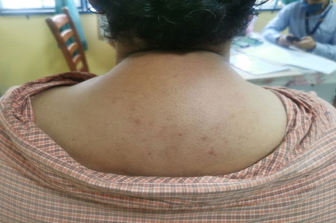 picture of Cushing's disease