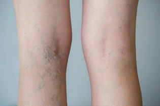 Image illustrative de l'article Démangeaisons des jambes : 9 causes (et que faire)