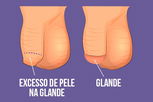 Imagem ilustrativa do artigo Circuncisão: o que é, como é feita, recuperação e riscos