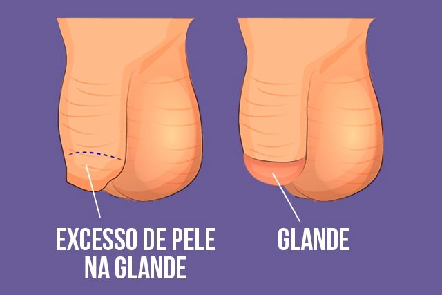 Antes e depois da circuncisão