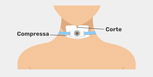 Imagem ilustrativa do artigo Traqueostomia: o que é, para que serve e cuidados