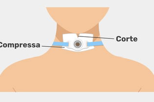 Imagem ilustrativa do artigo Traqueostomia: o que é, para que serve e cuidados