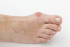 Illustrative image of the article Bunion: Symptoms, Causes & Treatment