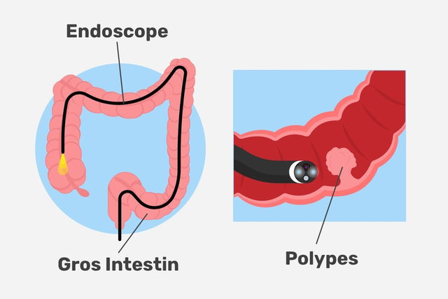 représentation du gros intestin et de l'endoscope visualisant un polype