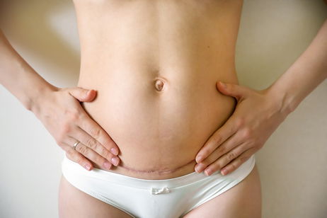 Image illustrative de l'article Cicatrice de césarienne: types et comment l'atténuer 