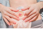 Imagen ilustrativa del artículo Ostomía: qué es, tipos, cuándo está indicada y cuidados