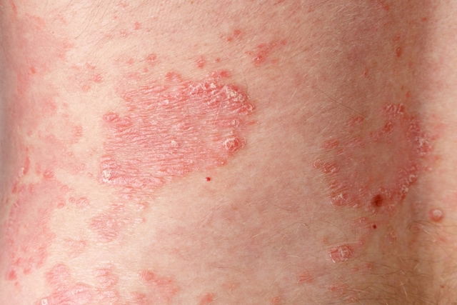 Heridas de psoriasis genital