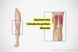 Imagem ilustrativa do artigo Lipossarcoma: o que é, sintomas e tratamento