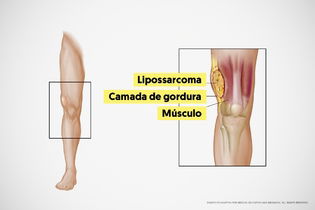 Imagem ilustrativa do artigo Lipossarcoma: o que é, sintomas e tratamento