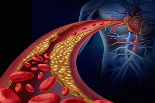 Imagen ilustrativa del artículo Aterosclerosis: qué es, síntomas, causas y tratamiento