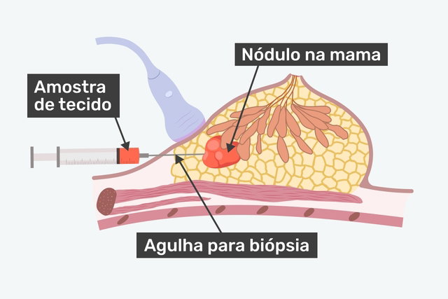 Biópsia da mama: como é feita, quando fazer e resultados - Tua Saúde