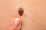 Imagem ilustrativa do artigo Melanoma nodular: o que é, sintomas, causas e tratamento