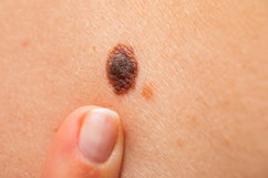 Imagem ilustrativa do artigo Melanoma nodular: o que é, sintomas, causas e tratamento