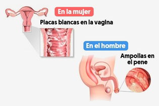 Imagen ilustrativa del artículo Síntomas de candidiasis genital, oral, en la piel, intestinal y en uñas