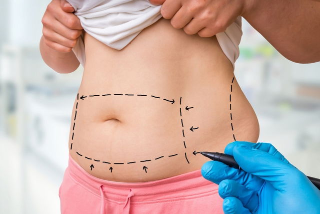 Cirurgião plástico fazendo marcação na pele de paciente para a abdominoplastia