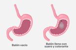 Imagen ilustrativa del artículo Balón gástrico: qué es, cómo funciona, ventajas y desventajas