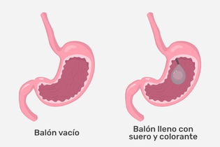 Imagen ilustrativa del artículo Balón gástrico: qué es, cómo funciona, ventajas y desventajas