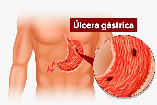 Illustrative image of the article Stomach Ulcer Symptoms: 7 Signs (with Online Symptom Checker)