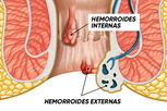 Imagen ilustrativa del artículo Hemorroides externas [almorranas]: qué son, síntomas y cómo eliminar