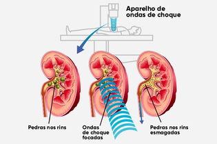 Imagem ilustrativa do artigo Cirurgia para pedra nos rins: quando fazer, tipos e recuperação