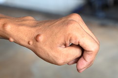 Illustrative image of the article Neurofibromatosis: Symptoms, Causes & Treatment