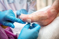 Imagen ilustrativa del artículo Piel de mariposa: qué es, síntomas, causas y tratamiento