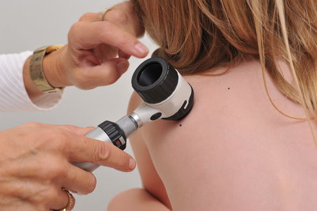 Imagen ilustrativa del artículo Pitiriasis: qué es, síntomas, tipos, causas y tratamiento