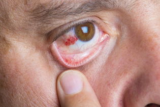 Illustrative image of the article Subconjunctival Hemorrhage: Symptoms, Causes & Treatment