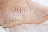 Image illustrative de l'article Pieds qui pèlent: 8 causes (et que faire)