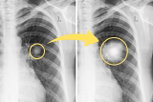 Imagen ilustrativa del artículo Nódulo pulmonar: qué es, síntomas y cuándo es cáncer